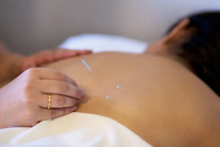 Acupuncture needles placed along the back
